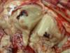 traumatic haemorrhage in thalamus